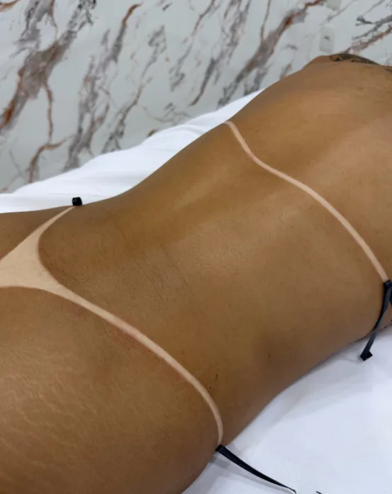 Resultado de bronzeamento corporal realizado na Blossom